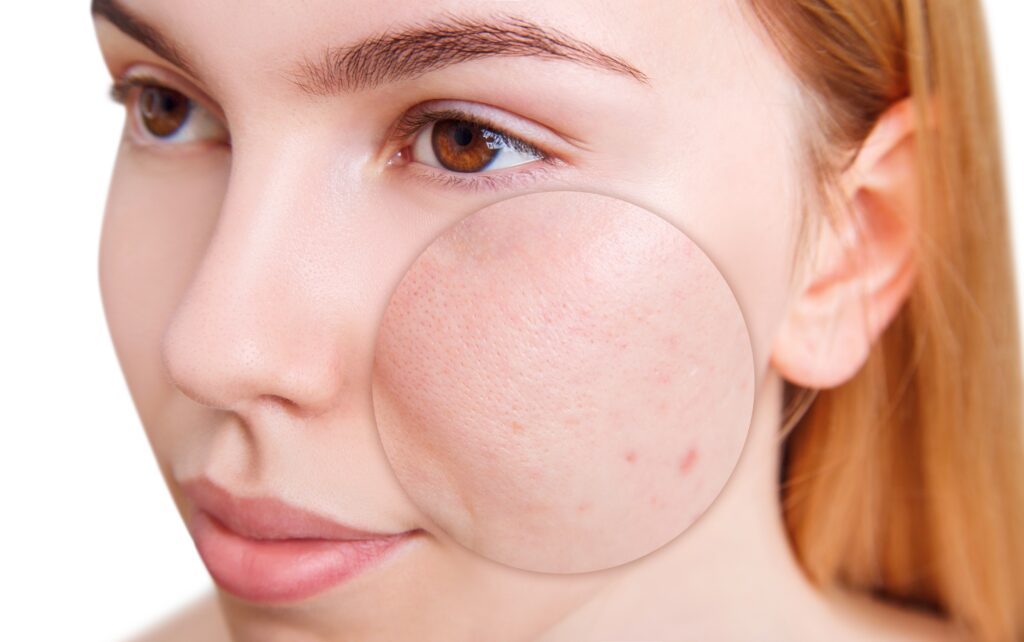 Laser Treatment for Redness & Rosacea 3 shutterstock 2218442201 Villar Wellness & Aesthetics