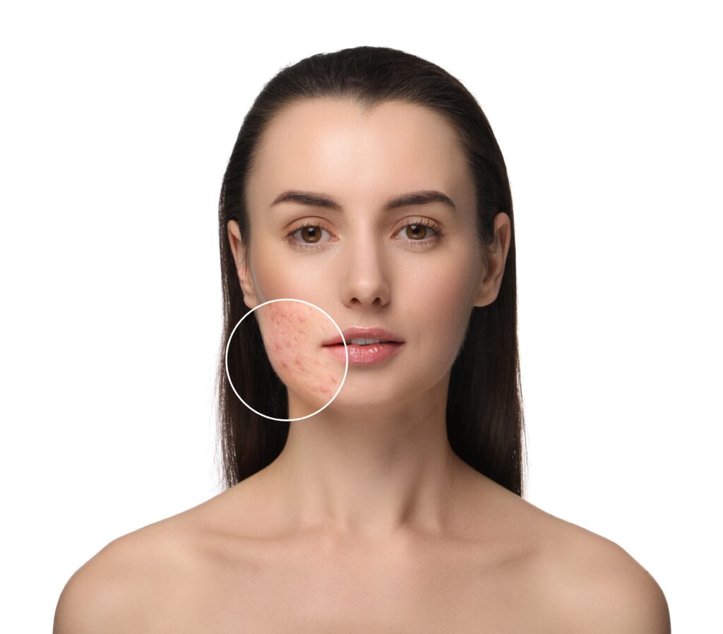 IPL for Acne & Congestion 4 shutterstock 2425279189 Villar Wellness & Aesthetics